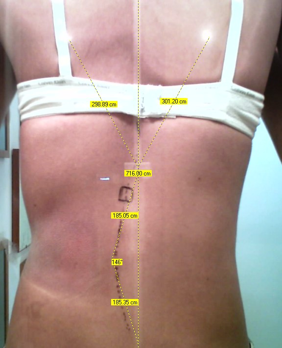 RX scoliosi – esempio 3