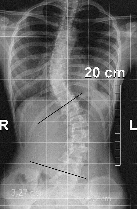 Radiografia scoliosi (esempio)